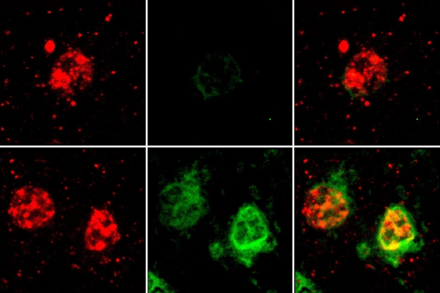 Oligodendrocytes from a patient with Alzheimer’s (bottom row) and a non-Alzheimer’s subject (top row) are labeled in red. The green stain reveals a protein encoded by a gene called QDRP, which MIT researchers found is expressed at much higher levels in oligodendrocytes from Alzheimer’s patients.
