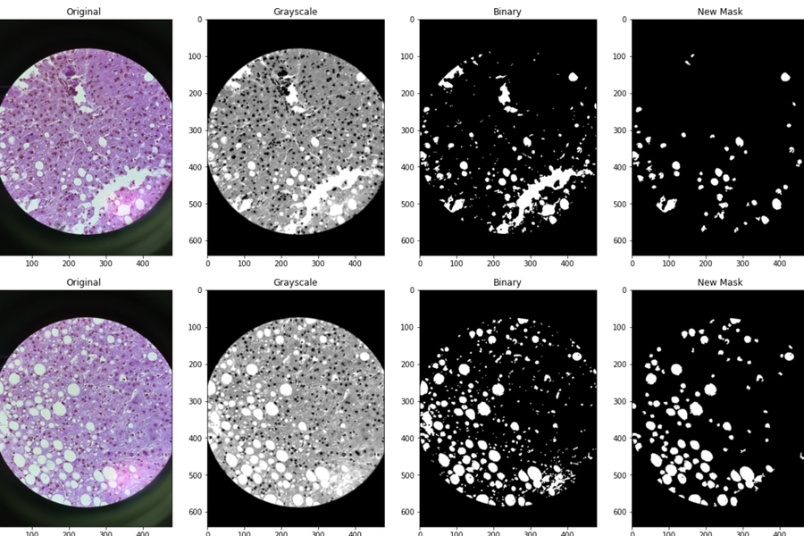 To speed up the process of screening viable livers for transplant, researchers developed an image segmentation model that isolates fat globules in a tissue slide and estimates the liver’s overall fat content. 
