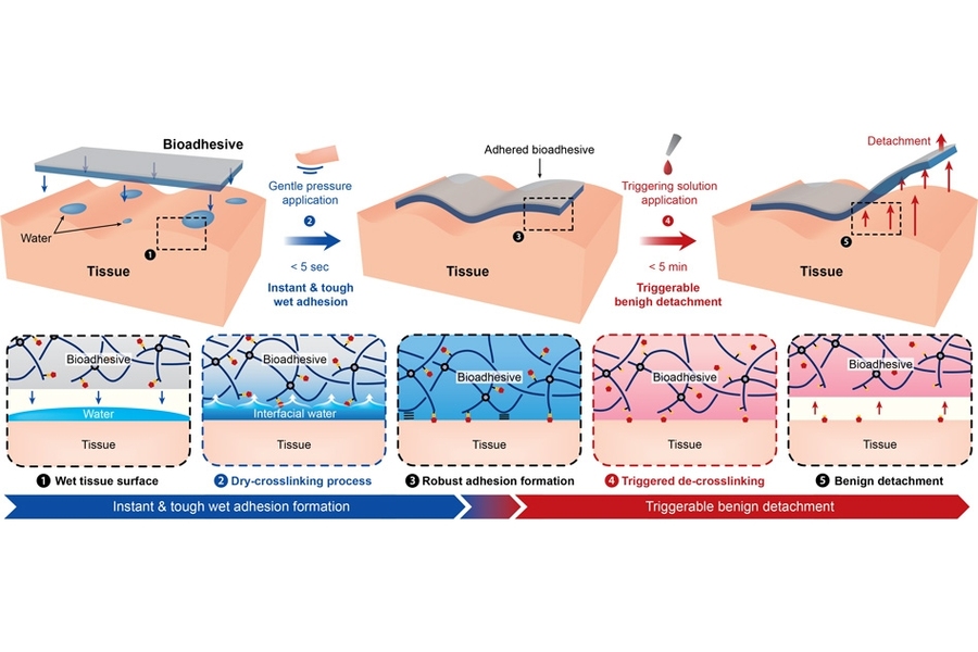 A new type of super-strong surgical tape developed at MIT detaches on demand. The removable adhesive could make it easier for surgeons to close up internal wounds.
