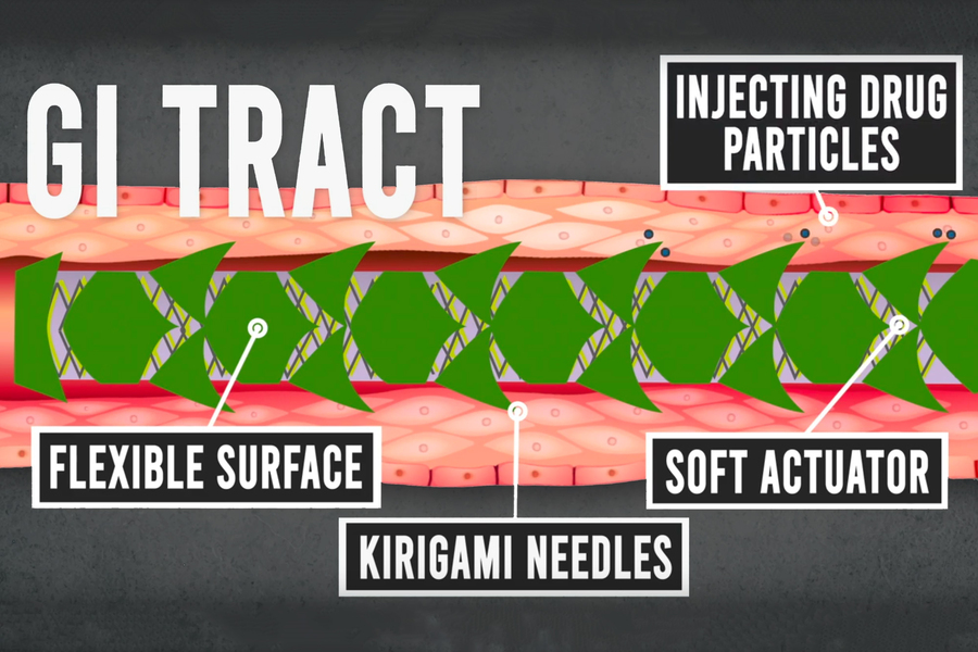 gi tract graphic with stent
