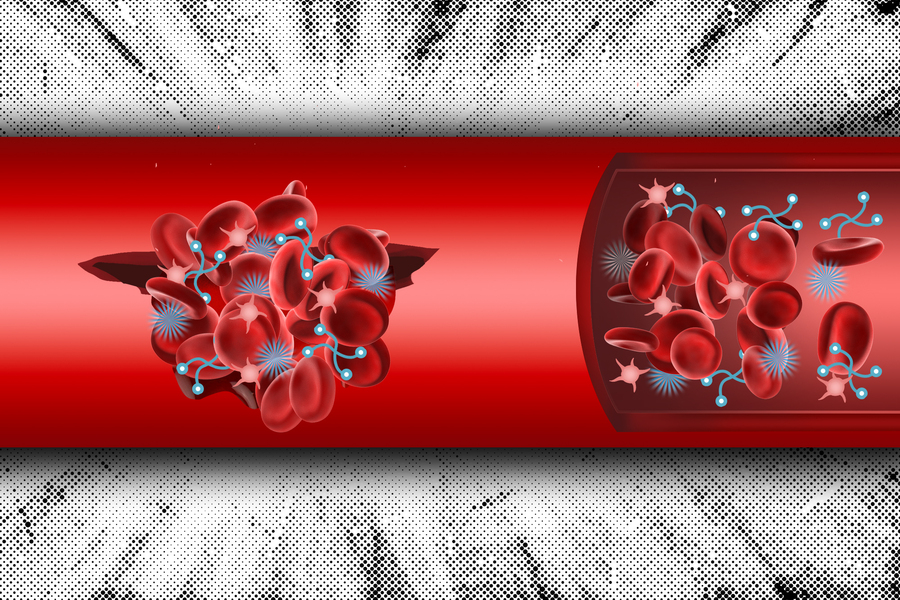 A tubular red vein is on a decorative background. Inside, 2 clumps of red blood cells are clotting, thanks to two types of nanoparticles, depicted as light blue and white icons.