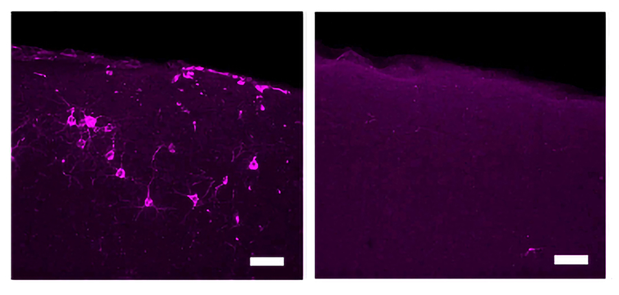 Two panels show a section of mouse brain tissue with a dull magenta glow over a black background. In the left panel many neurons are lit up brightly in magenta. In the right panel only one neuron is lit up brightly.