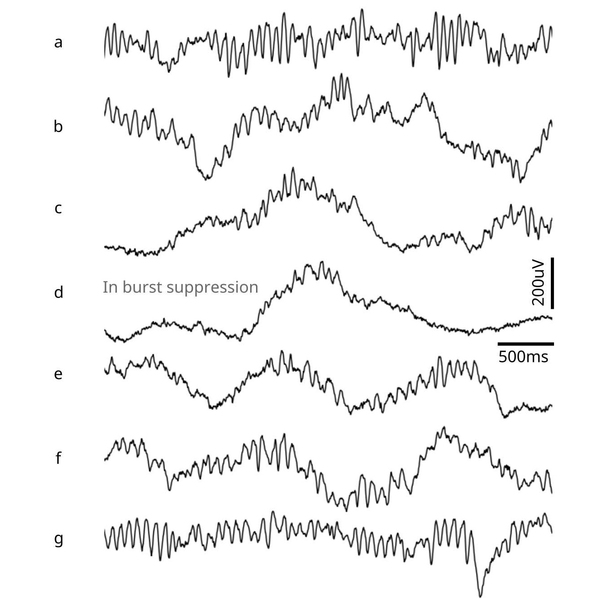 7 examples of brain waves are shown as black lines going from left to right, from a-g. Line (d) has a label that says, “In burst suppression,” and is the most flattened of the wavey lines.