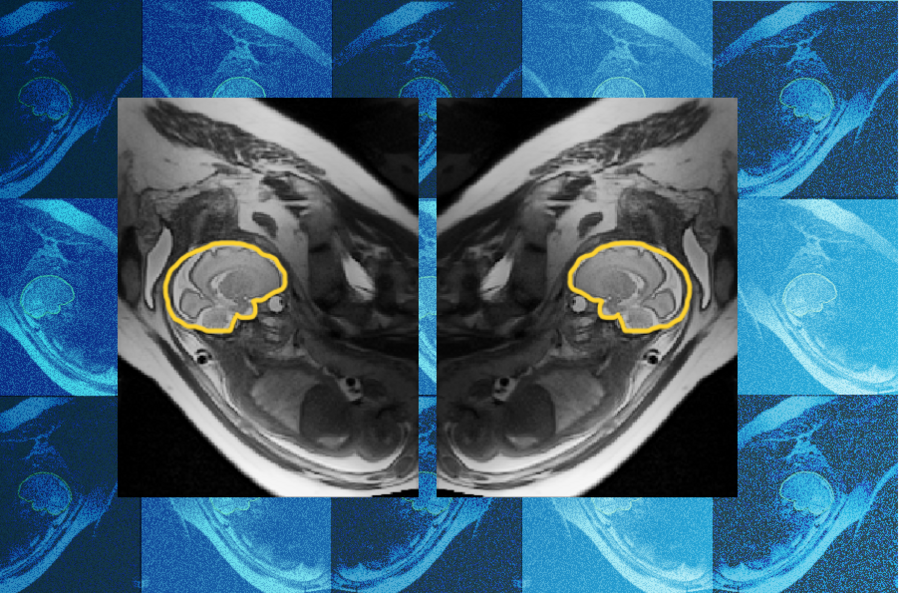 Greyscale fetal MRI showing two mirrored views of a fetus in the womb, with the fetal brain outlined in yellow in each image. A tiled blue background pattern of similar fetal brain scans is in the background