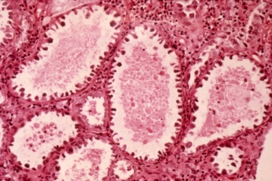 Shown here is an image of a clear cell adenocarcinoma composed of tubles lined by hobnail cells.
