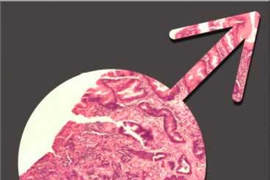 Cancerous lesions of the stomach lining, seen here, occur far more often in men than in women. MIT researchers say that discrepancy is due to the protective effects of estrogen during chronic H. pylori infection.