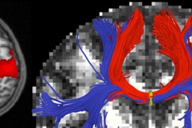 Left: A functional magnetic resonance imaging (MRI) scan with cortical regions strongly correlated with motor activity highlighted in red. Right: A diffusion MRI scan with white-matter bundles passing through the corpus callosum shown in blue and red.