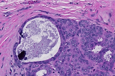 Photomicrograph of a microcalcification associated with breast cancer.