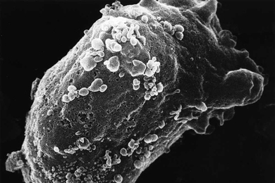 Scanning electron microscope image of a lymphocyte with HIV cluster.