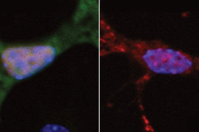 At left, a neuron exhibits normal DNA repair, indicated by green fluorescence. At right, a neuron with a mutated form of the FUS protein found in ALS patients shows very little DNA repair. 