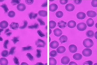 As red blood cells from sickle cell patients flow through the new MIT microfluidic device, many of them become sickled following exposure to a low-oxygen environment (left). At right, when oxygen levels are restored, the cells resume their normal shape.
