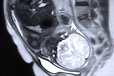 A team led by Polina Golland’s group at MIT’s Computer Science and Artificial Intelligence Laboratory has made a new algorithm for identifying organs in fetal MRI scans, which should make MRI monitoring much more useful. Pictured is a stock image of a fetal MRI.
