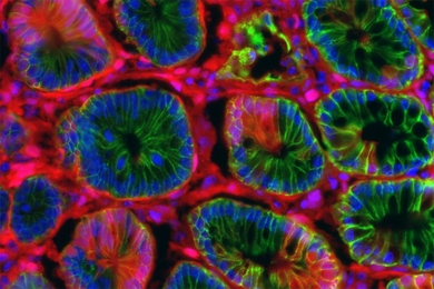 MIT researchers created this colon tumor by delivering RNA encapsulated in lipid nanoparticles to the colon. The RNA can activate or delete specific genes, leading to tumor growth.
