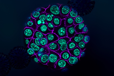 Colorized pancreatic cancer cells in teal encased in purple membranes.